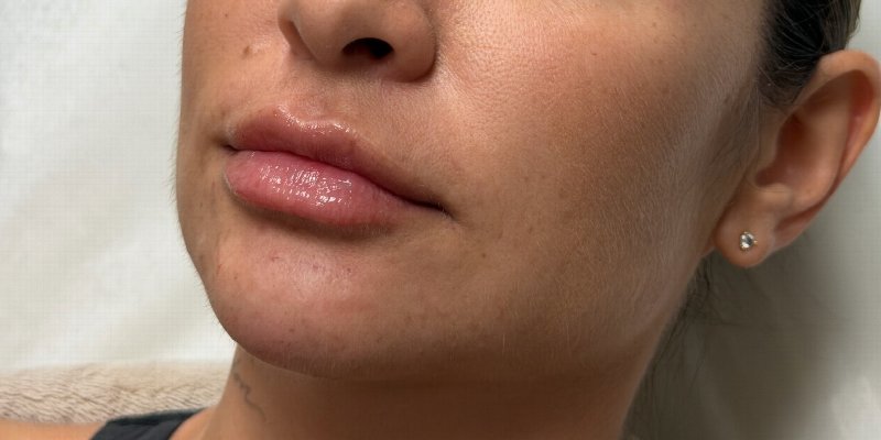 Dermal Fillers Before & After Image