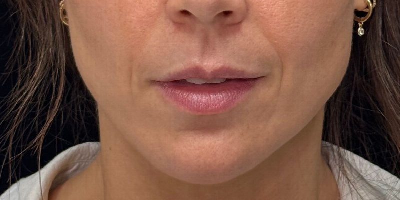 Dermal Fillers Before & After Image