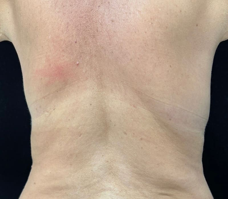 Fat Loss Injection Before & After Image