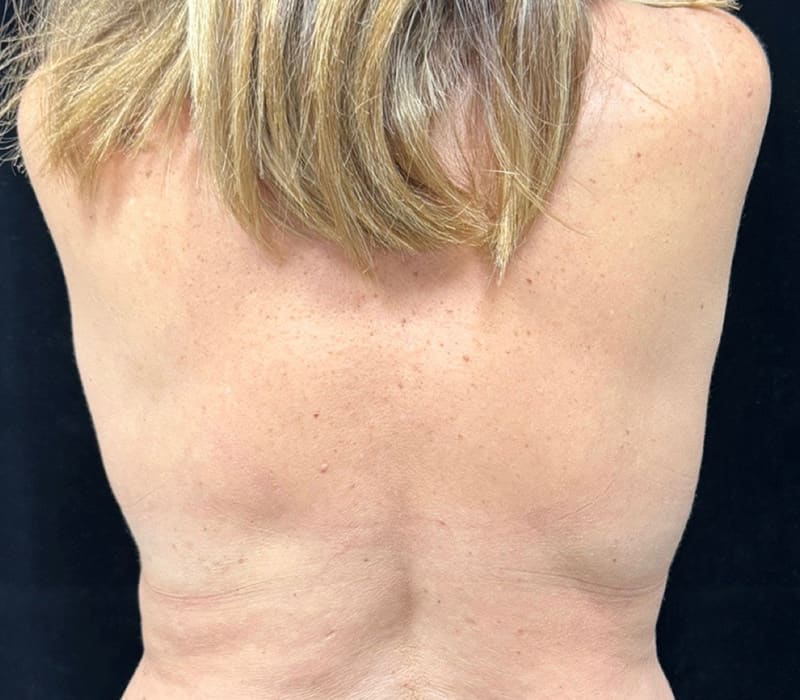 Fat Loss Injection Before & After Image