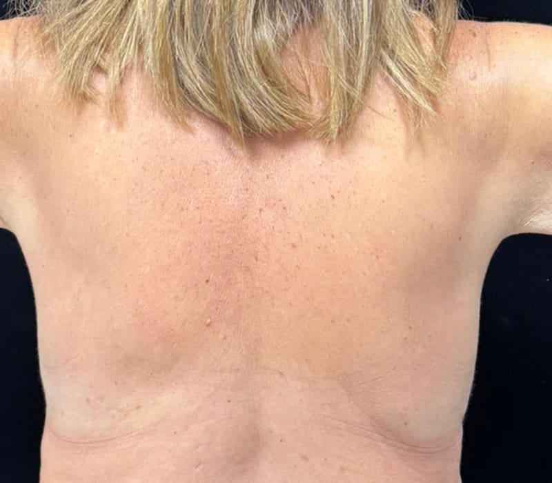 Fat Loss Injection Before & After Image