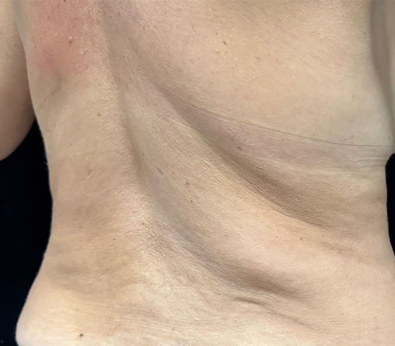 Fat Loss Injection Before & After Image