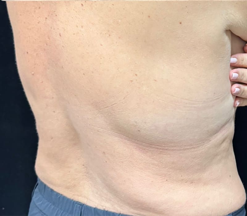 Fat Loss Injection Before & After Image