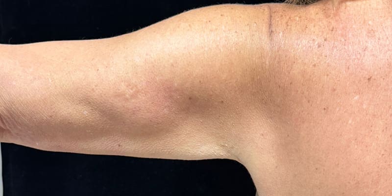 Fat Loss Injection Before & After Image