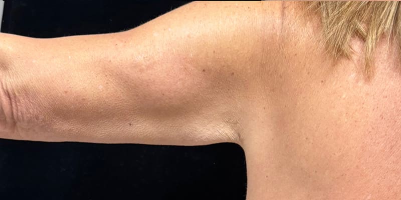 Fat Loss Injection Before & After Image