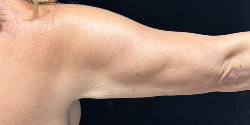 Fat Loss Injection Before & After Image