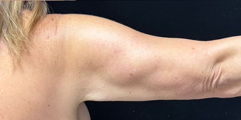 Fat Loss Injection Before & After Image