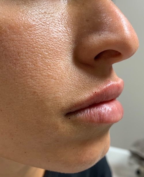 Lip Fillers Before & After Image