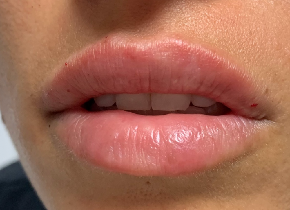 Lip Fillers Before & After Image