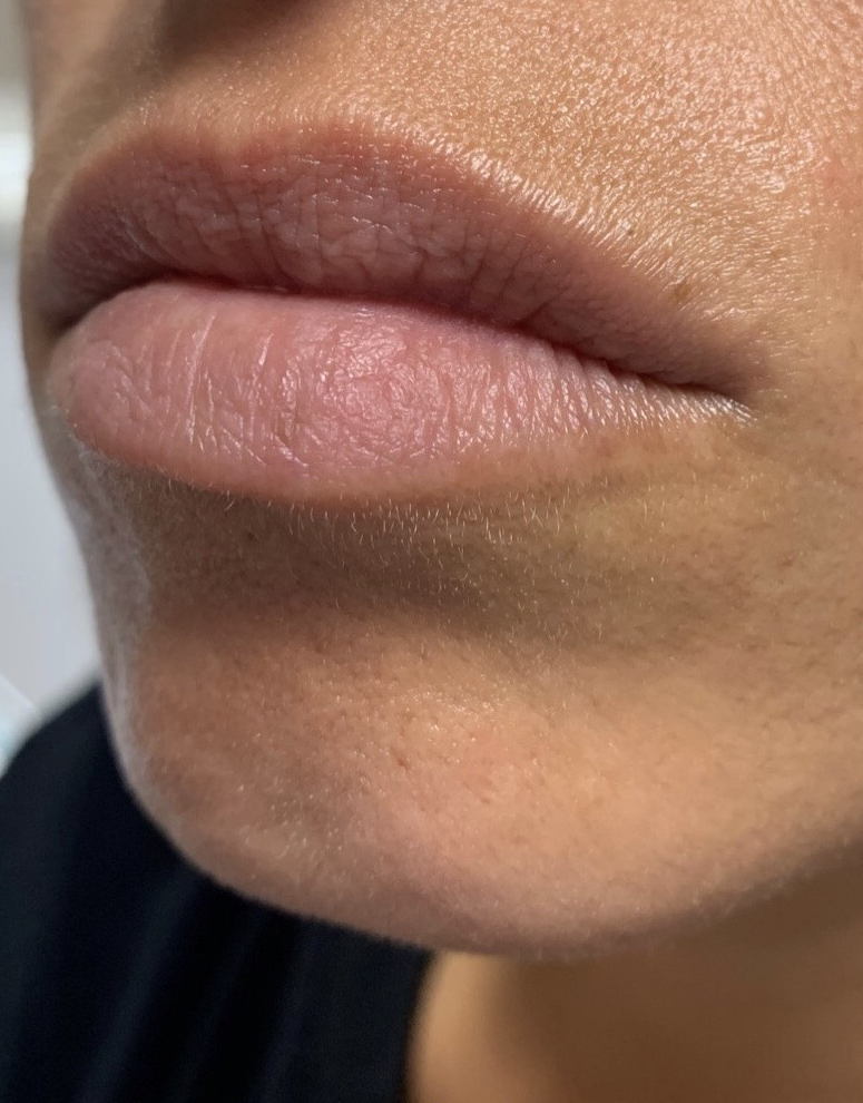 Lip Fillers Before & After Image