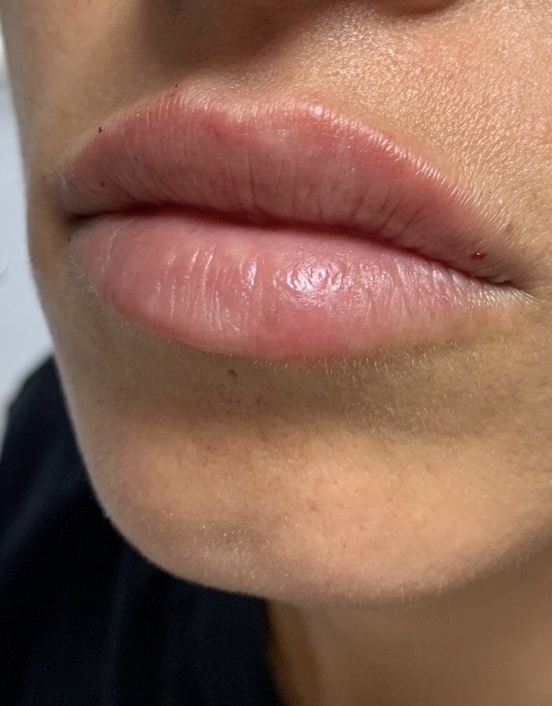 Lip Fillers Before & After Image