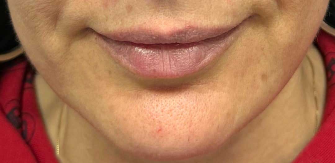 Lip Fillers Before & After Image