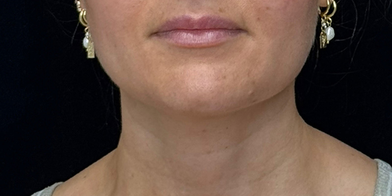Lip Fillers Before & After Image