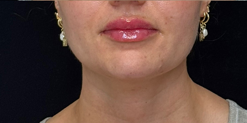 Lip Fillers Before & After Image