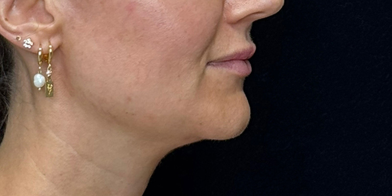 Lip Fillers Before & After Image