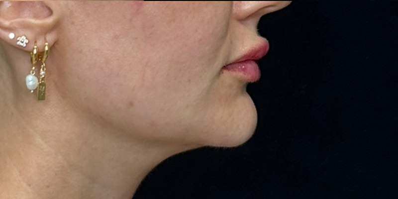 Lip Fillers Before & After Image