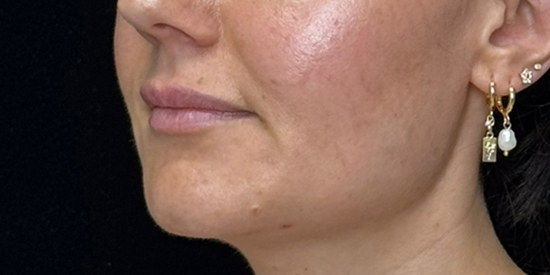 Lip Fillers Before & After Image
