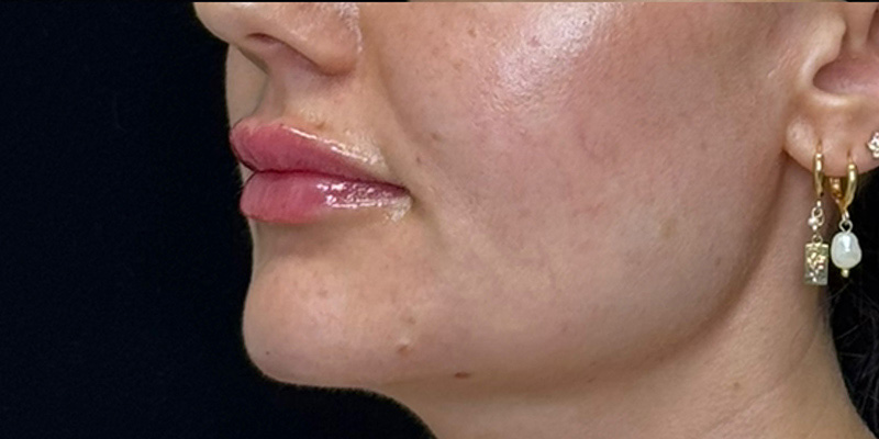 Lip Fillers Before & After Image
