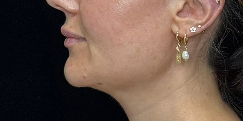 Lip Fillers Before & After Image