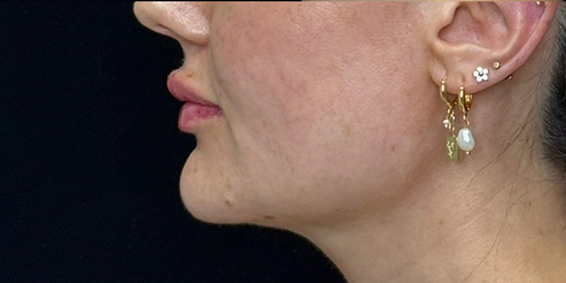 Lip Fillers Before & After Image