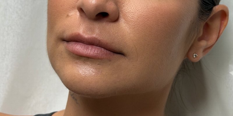 Lip Fillers Before & After Image