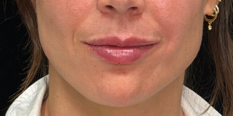 Lip Fillers Before & After Image