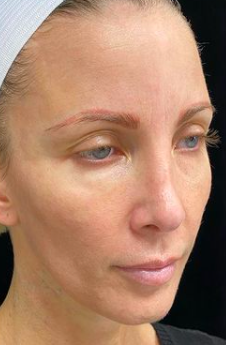 Liquid Facelift Before & After Image