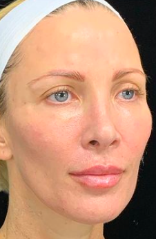 Liquid Facelift Before & After Image