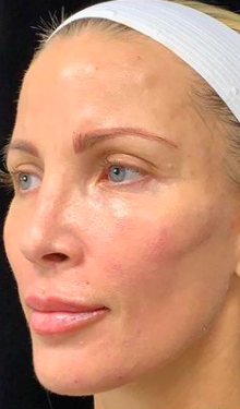 Liquid Facelift Before & After Image