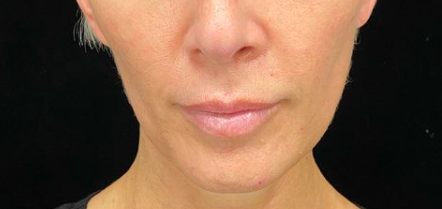 Liquid Facelift Before & After Image