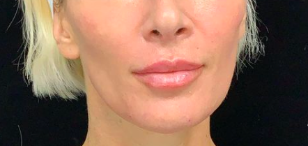 Liquid Facelift Before & After Image