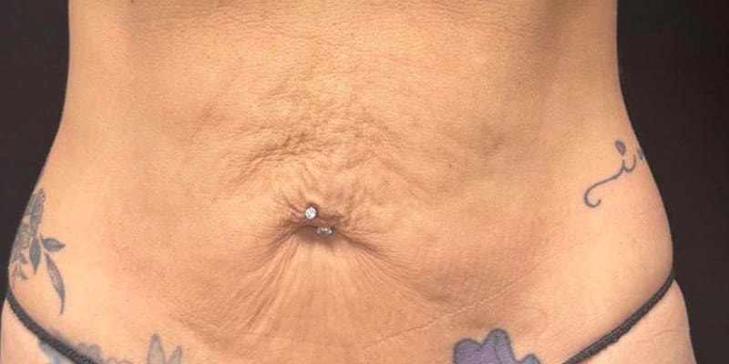 Skin Tightening Injection Before & After Image