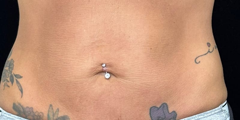Skin Tightening Injection Before & After Image