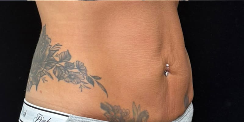 Skin Tightening Injection Before & After Image