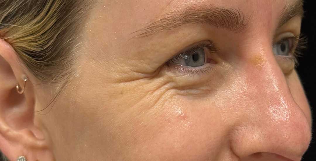 Xeomin Before & After Image