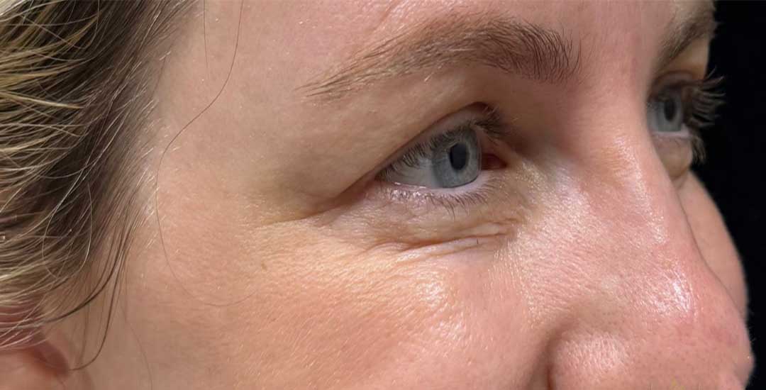 Xeomin Before & After Image
