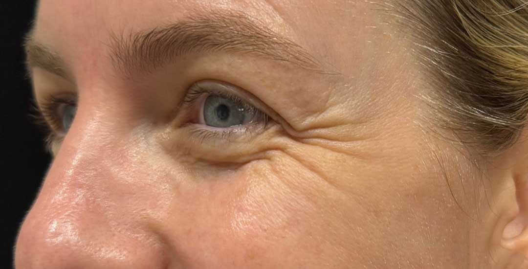 Xeomin Before & After Image