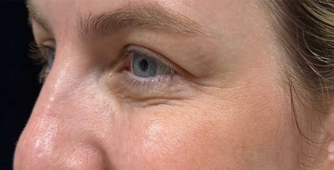 Xeomin Before & After Image
