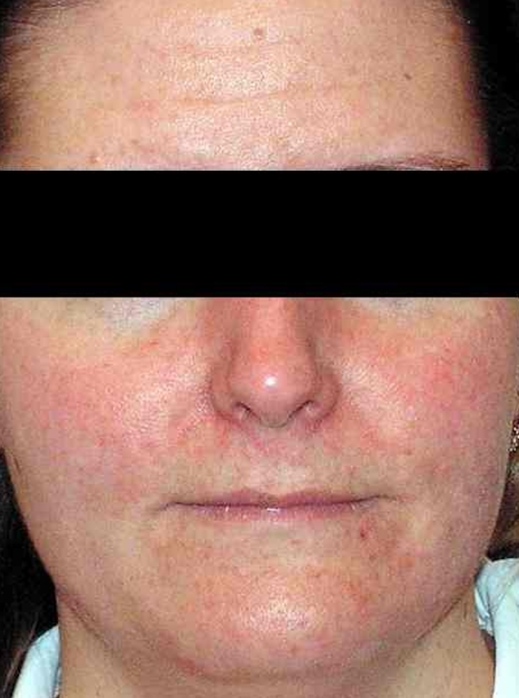 2 D Skin Revitalization Before & After Image