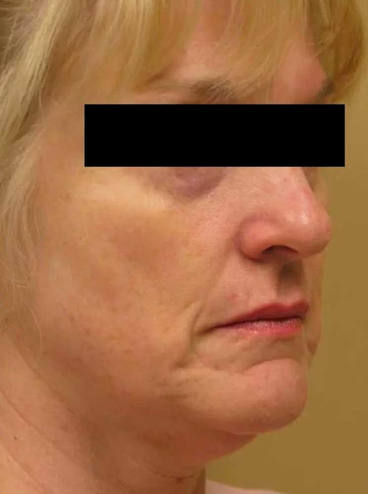 3 D Skin Revitalization Before & After Image