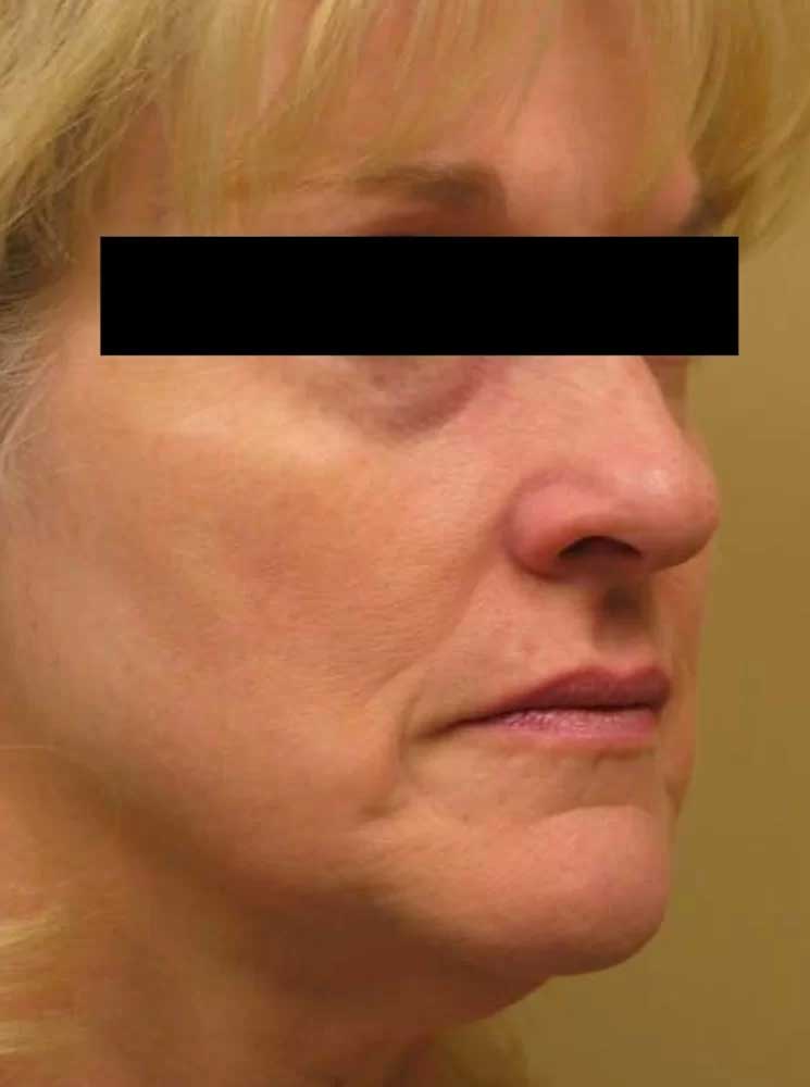 3 D Skin Revitalization Before & After Image