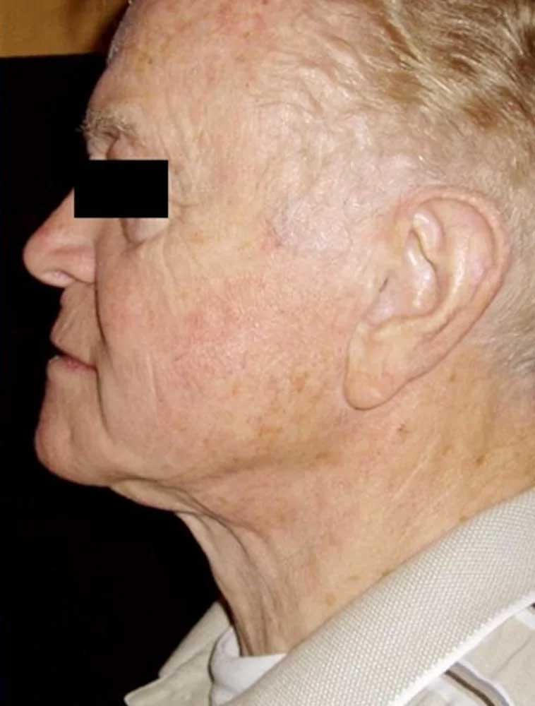 3 D Skin Revitalization Before & After Image