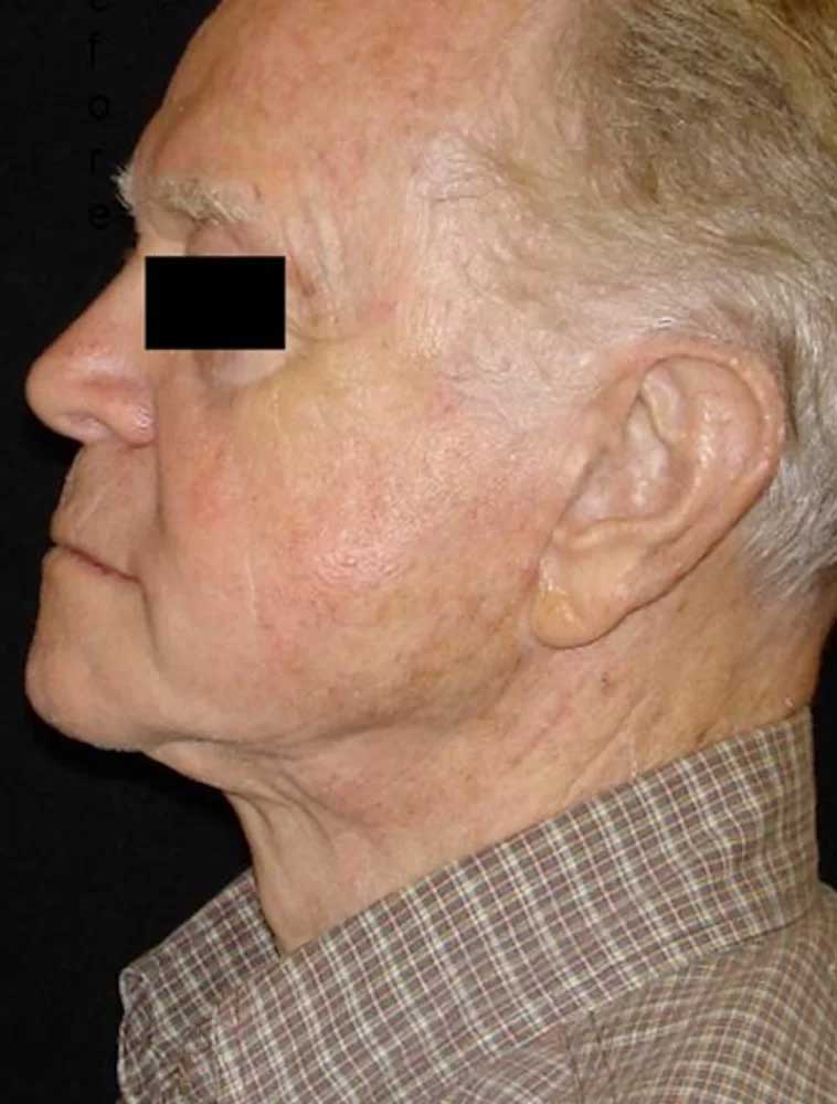 3 D Skin Revitalization Before & After Image