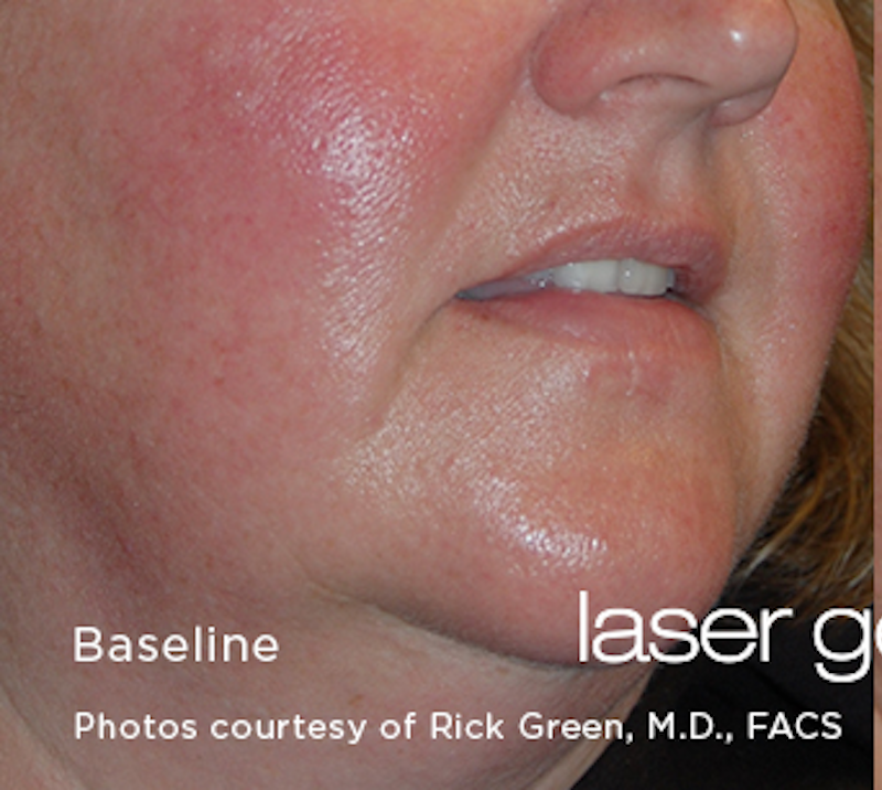 Laser Genesis Before & After Image