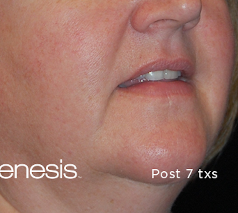 Laser Genesis Before & After Image