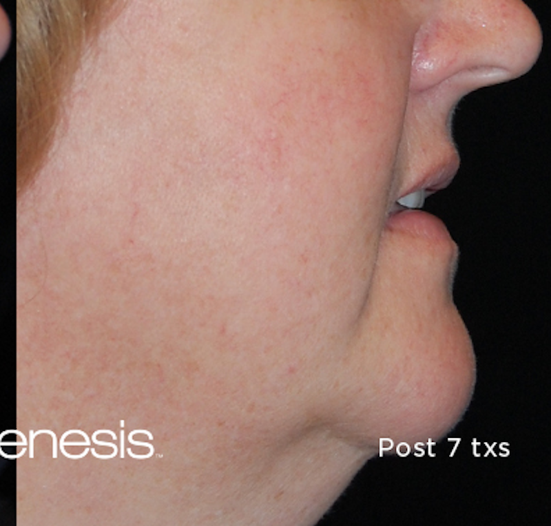 Laser Genesis Before & After Image