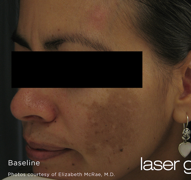 Laser Genesis Before & After Image