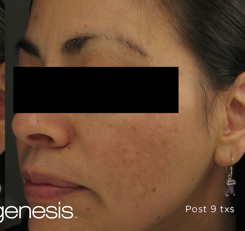 Laser Genesis Before & After Image