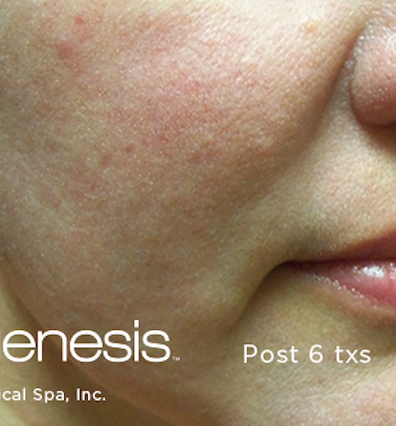 Laser Genesis Before & After Image