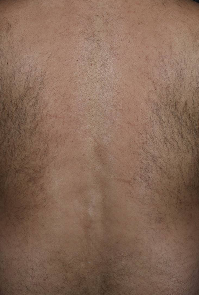 Laser Hair Removal  Before & After Image